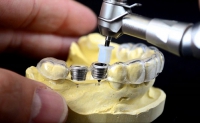 SỰ QUAN TRONG CỦA MÁNG ĐỊNH HƯỚNG PHẪU THUẬT IMPLANT 3D