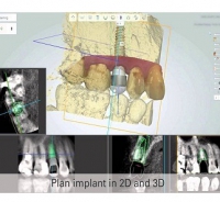 NHỮNG LỢI THẾ KHI DÙNG CÔNG NGHỆ 3D TRONG PHẪU THUẬT IMPLANT