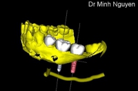 CASE IMPLANT 1- SỬ DỤNG MÁNG HƯỚNG DẪN IMPLANT