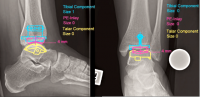 PHẦN MỀM MEDICAD 2D - MÔ ĐUN “FOOT” HỖ TRỢ PHẪU THUẬT CHỈNH HÌNH BÀN CHÂN 