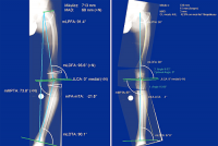 CHỨC NĂNG NẮN CHỈNH XƯƠNG CỦA PHẦN MỀM MediCAD 2D –MÔ ĐUN LONG LEG