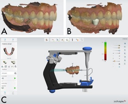 THIẾT KẾ MÁNG HƯỚNG DẪN PHẪU THUẬT VỚI PHẦN MỀM IMPLANT STUDIO